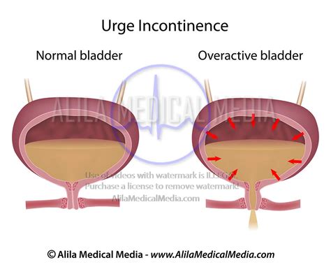 Alila Medical Media | Urge urinary incontinence in women | Medical illustration