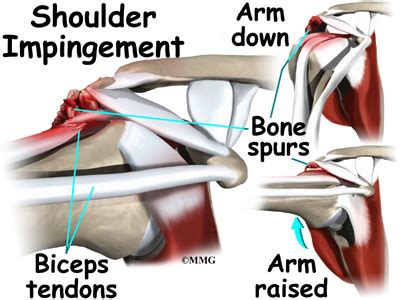 Biceps Rupture | eOrthopod.com