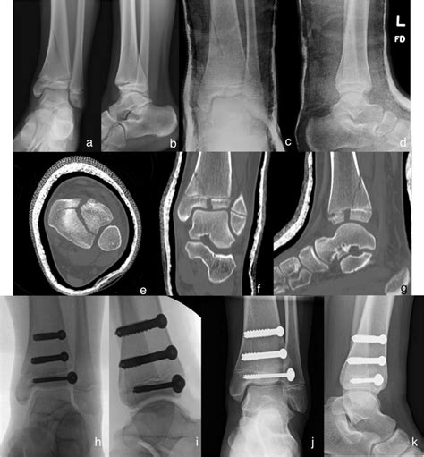 A 12-year-old female sustained this triplane fracture due to a twisting ...