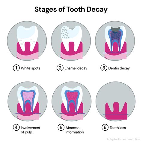 Tooth Cavity Stages