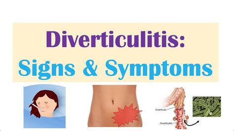 Diverticulitis Signs & Symptoms (And Why They Occur) - YouTube | Diverticulitis, Signs and ...