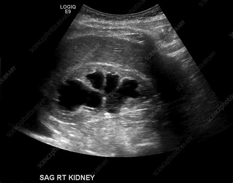 Hydronephrosis, ultrasound - Stock Image - C039/3879 - Science Photo ...