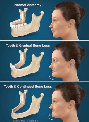 BONE LOSS & OTHER CONSEQUENCES OF TOOTH LOSS - Origins Dentistry