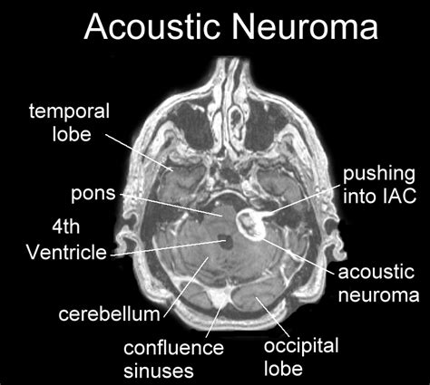 Vestibular Schwannoma (Acoustic Neuroma) - Best Treatment