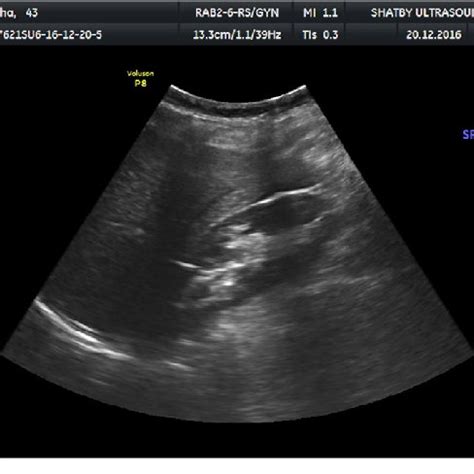 2D ultrasound view showing unicornuate uterus with adenomyosis on... | Download Scientific Diagram