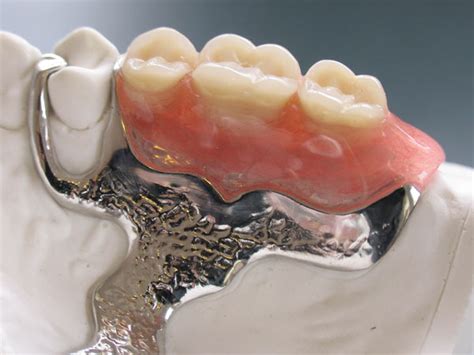 Dentures - CW Dental Lab