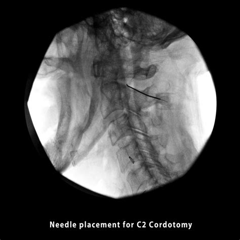 C2 Cordotomy - Samer Narouze, MD, PhD