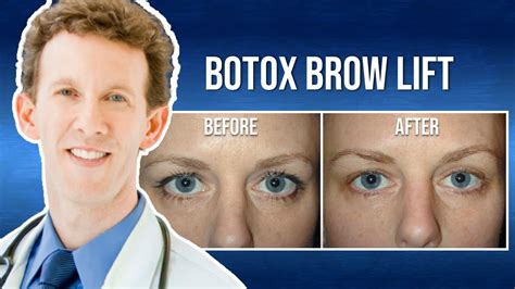 Medical Minute: What is a Botox Brow Lift? - YouTube