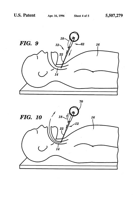 Patent US5507279 - Retrograde endotracheal intubation kit - Google Patents