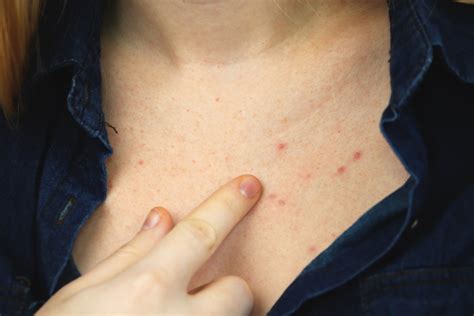 Chest Acne: What Causes It and How To Get Rid of It