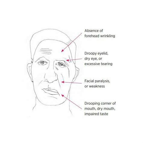 Bell's Palsy - Neurospace