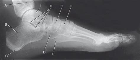 DIAGRAM - Foot Anatomy X-Ray (Lateral View) Diagram | Quizlet