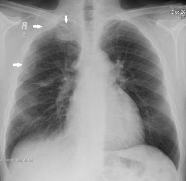 Malignant Mesothelioma Imaging: Overview, Radiography, Computed Tomography