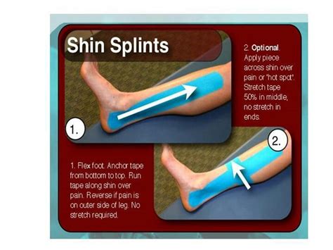 Shin splints with Terra tape | Shin splints, Kinesiology taping, Shin splints taping