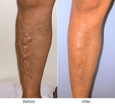 Varicose Vein Treatment: Ultrasound Guided Sclerotherapy | Midwest Vein Care