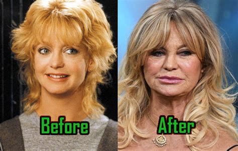 Goldie Hawn Plastic Surgery: Facelift, Injections, Before After! | CelebritySurgeryIcon