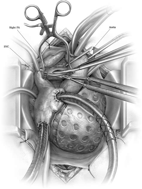 Operative Technique in Pulmonary Thromboendarterectomy - Operative ...