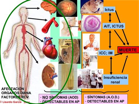 Lesión de Organos diana en la HTA. Como detectarlas desde la Atención…