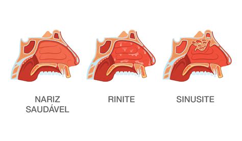 Sabe a diferença entre Rinite e Sinusite?