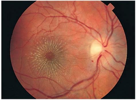 Optic Nerve Disorders | Ento Key