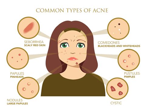 Acne: What causes acne problems?
