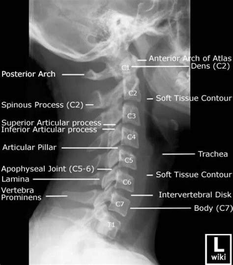 C-spine | Radiology student, Medical anatomy, Radiology schools