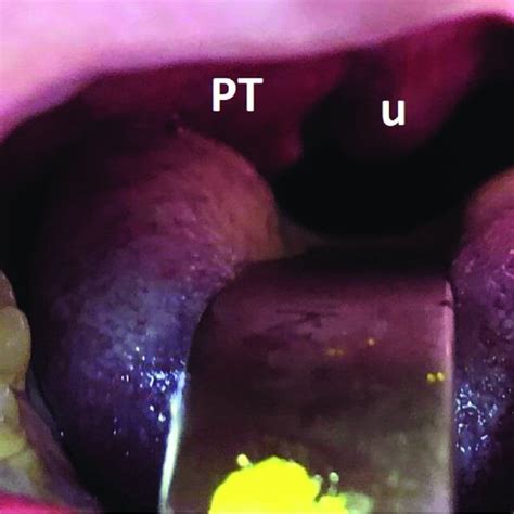 (PDF) Peritonsillar and Intratonsillar Abscess: A Review on Clinical Features, Managements and ...