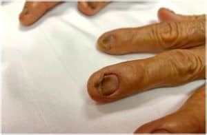 Koilonychia (Spoon Nails) - Definition, Symptoms, Causes, Prevention