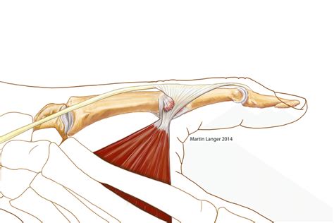 (PDF) Stener´s lesion Thumb ulnar collateral ligament