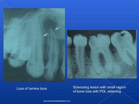 Lamina dura/ oral surgery courses