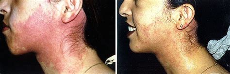 Port Wine Stain Removal | Washington, DC | Center for Laser Surgery