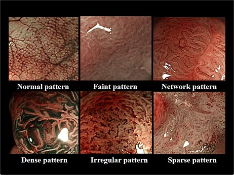 Narrow‐band imaging (NBI) magnifying endoscopic classification of colorectal tumors proposed by ...