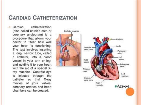 Pin by nonas arc on Catheter (Pediatric Heart Cath Procedure) | Cardiac ...