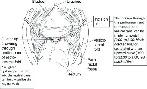 Incision and spatulation of remnant vaginal canal end. A. Midline ...