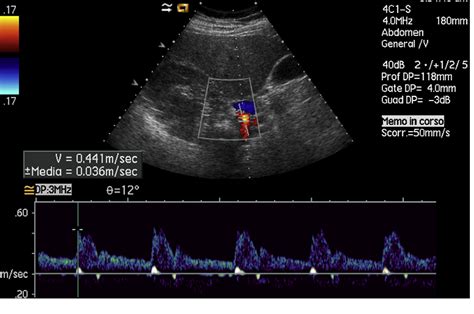 [PDF] Doppler ultrasound and renal artery stenosis: An overview. | Semantic Scholar