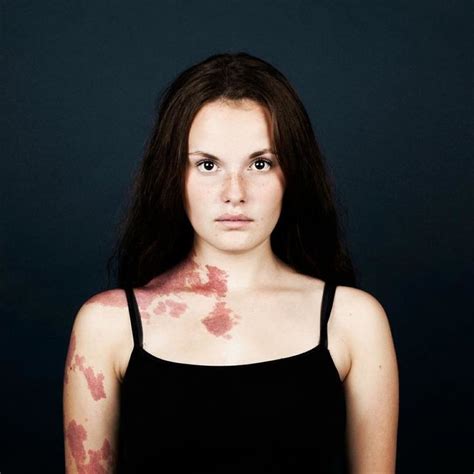 19 Portraits Of People With Birthmarks That Might Change The Way You See Them | Port wine stain ...