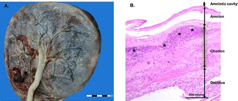 Chorioamnionitis Gross