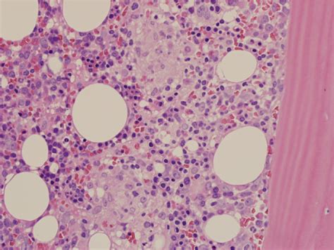 Bone marrow trephine biopsy shows granulomas. | Download Scientific Diagram