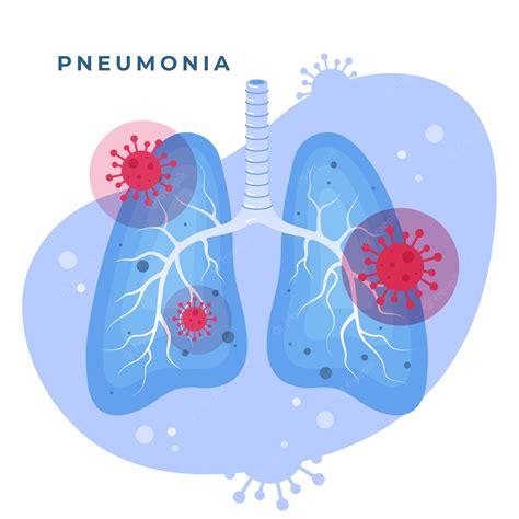 11,300+ Pneumonia Lungs Illustrations, Royalty-Free Vector - Clip Art Library