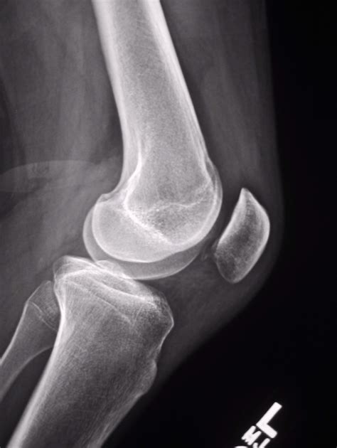 Patella X Ray