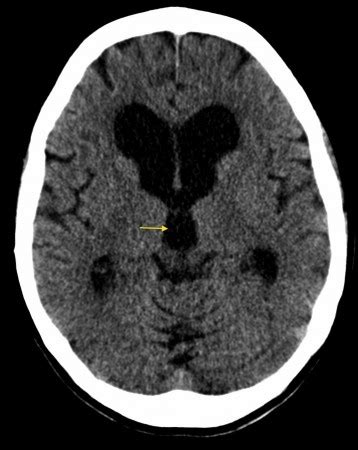 Normal pressure hydrocephalus - Radiology at St. Vincent's University Hospital