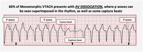 V-Fib: What Is It, Causes, Symptoms Treatment, 47% OFF