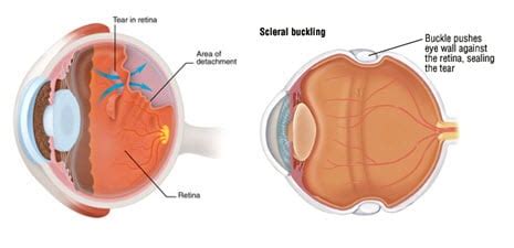 Retinal Detachment Treatment | Scleral Buckle | Bronx NY | New York City (NYC)