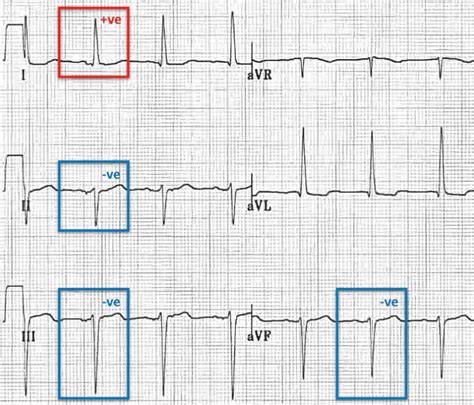 Atrial Flutter Litfl Ecg Library Diagnosis