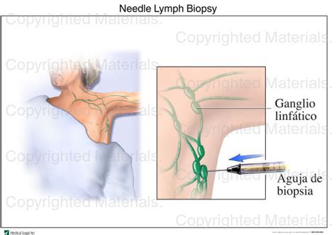 Schauspiel beschwichtigen Starren fine needle aspiration biopsy lymph ...