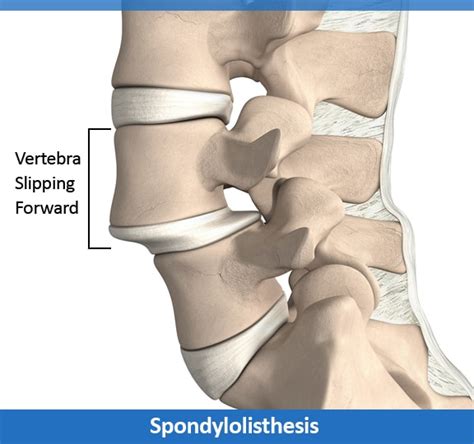 Spondylolisthesis Causes, Symptoms & Treatments