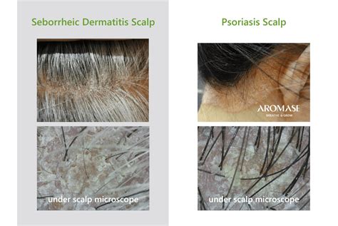 What's the Difference Between Psoriasis and Seborrheic Dermatitis Scalp? | AROMASE