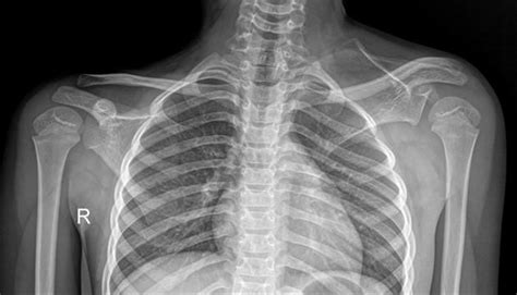 Sprengel deformity | Radiology Case | Radiopaedia.org | Radiology, Bone ...