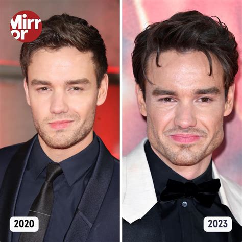 Liam Payne's Jaw Implants: A Comprehensive Look Into His Transformation