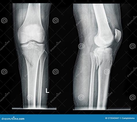 X Ray Broken Knee